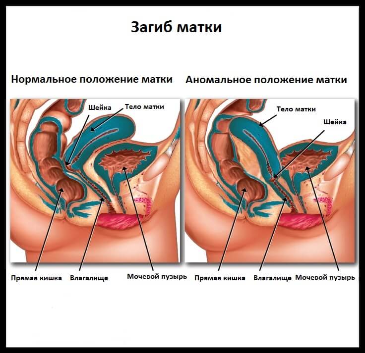 Загиб матки