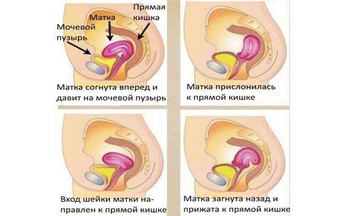 Загиб матки