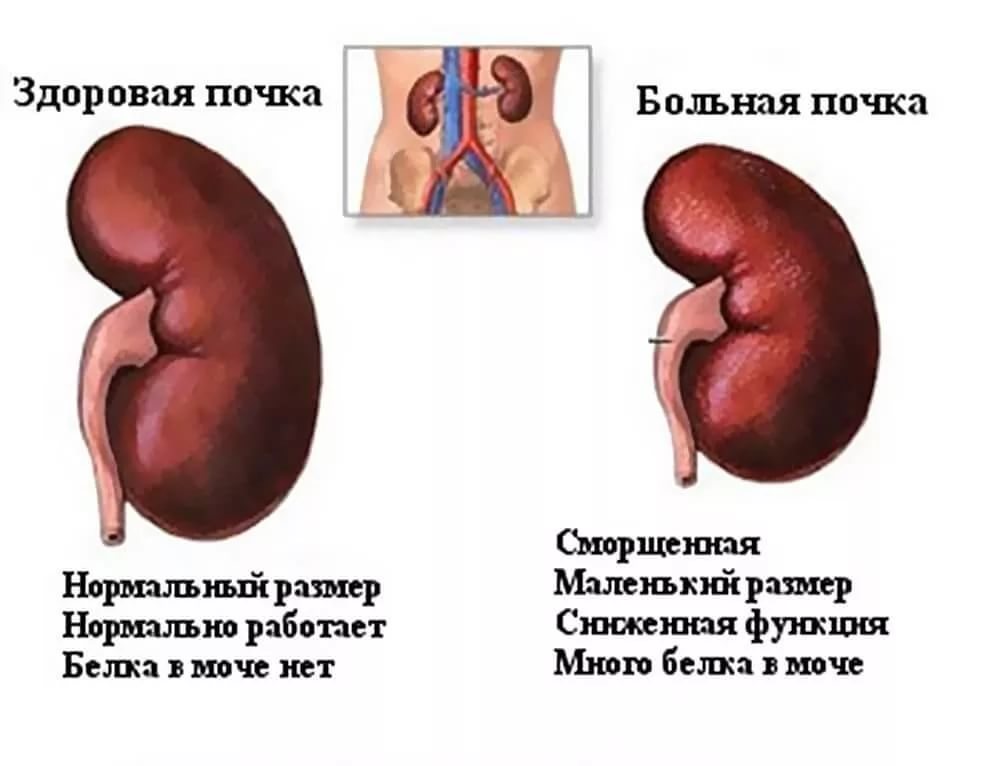 Здоровая и сморщенная почка