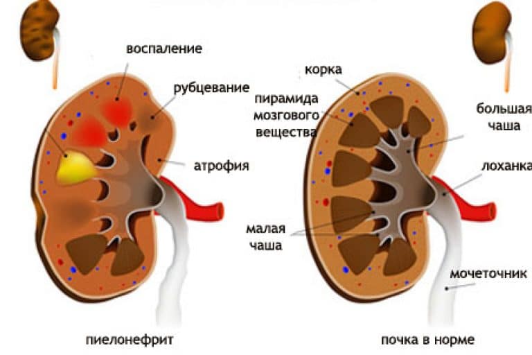 Здоровая почка и пиелонефрит