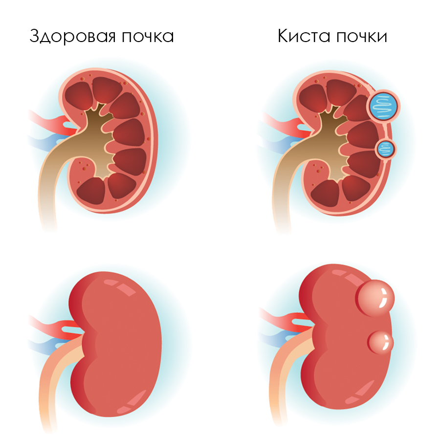 Здоровая почка и почка с кистой