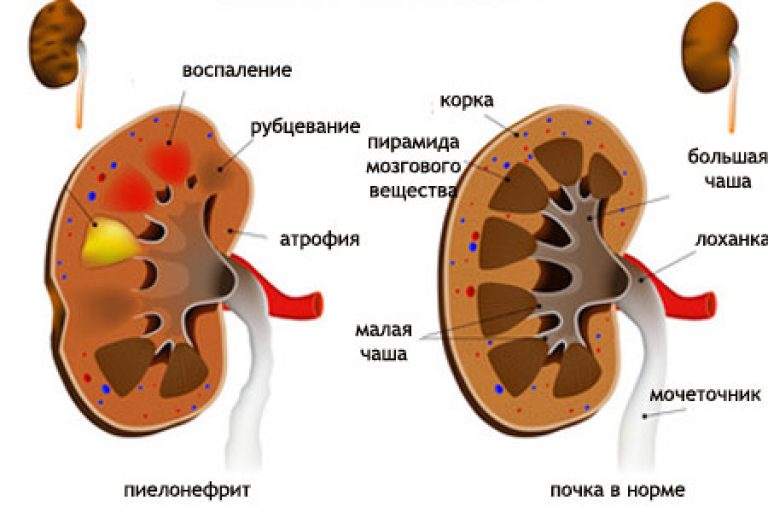 Здоровая почка и поражённая пиелонефритом
