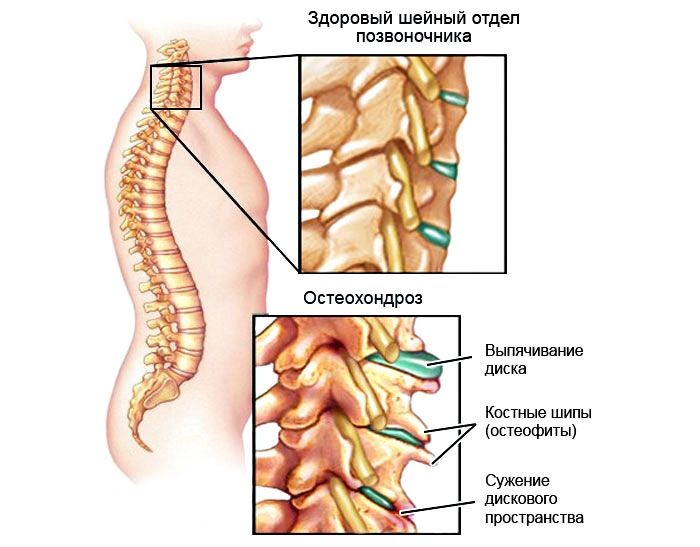 Здоровый и больной отделы позвоночника