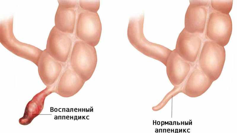Здоровый и воспалённый аппендикс