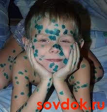 лечение сыпи при ветрянке зелёнкой