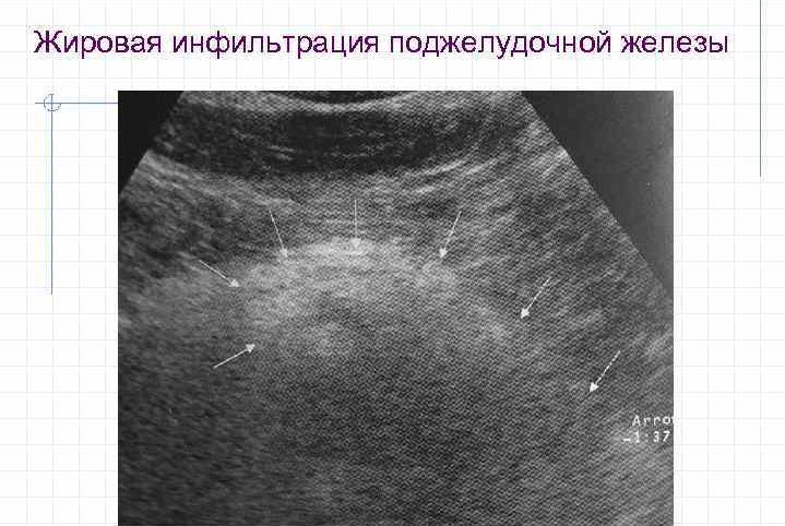 Что такое жировая инфильтрация поджелудочной и к чему она может привести?