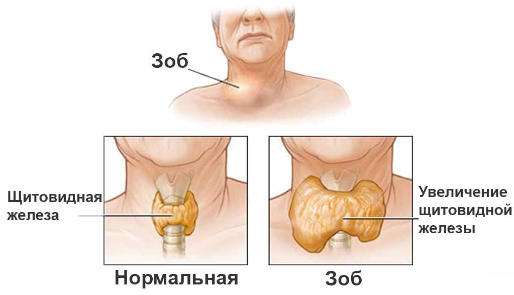Зоб щитовидной железы
